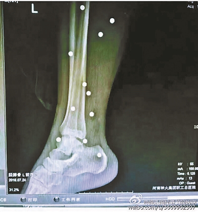 爆炸導致鋼珠遍布傷者身體各處